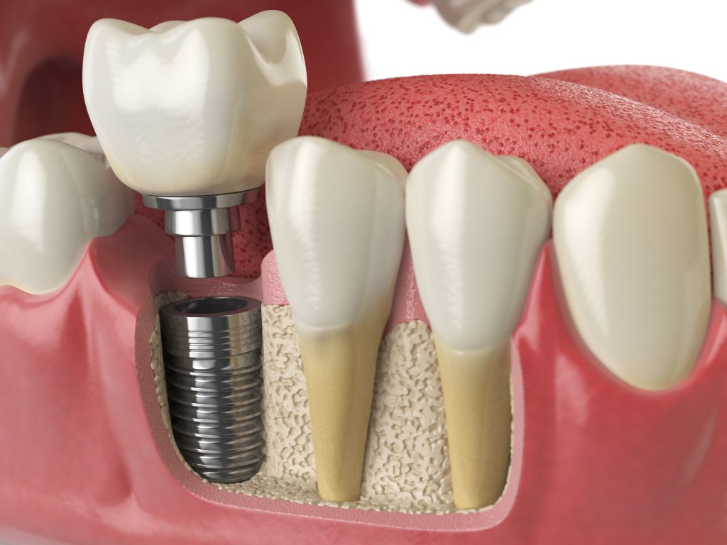 dental implant model for health and wellness